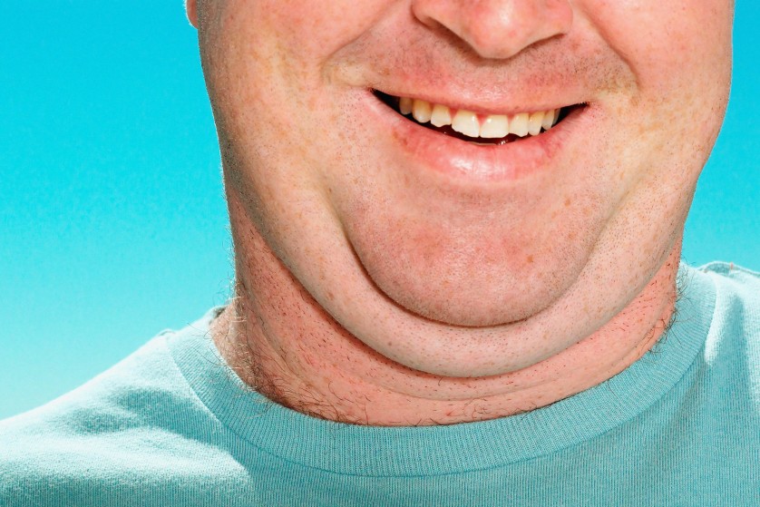 gordura-papo-queixo-838x559