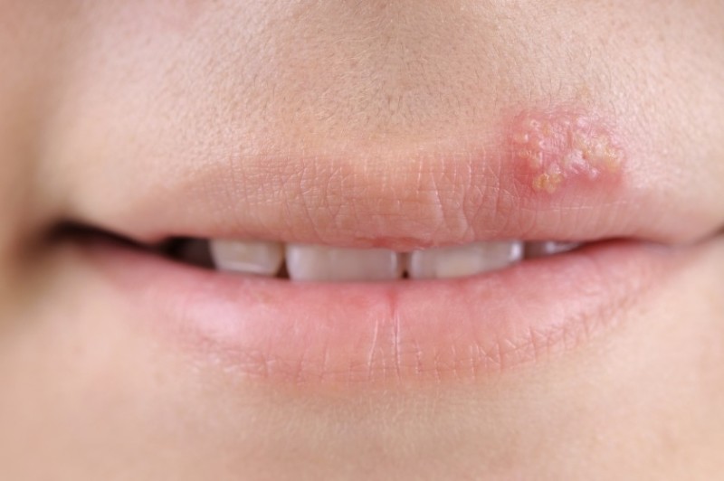 herpes-838x557