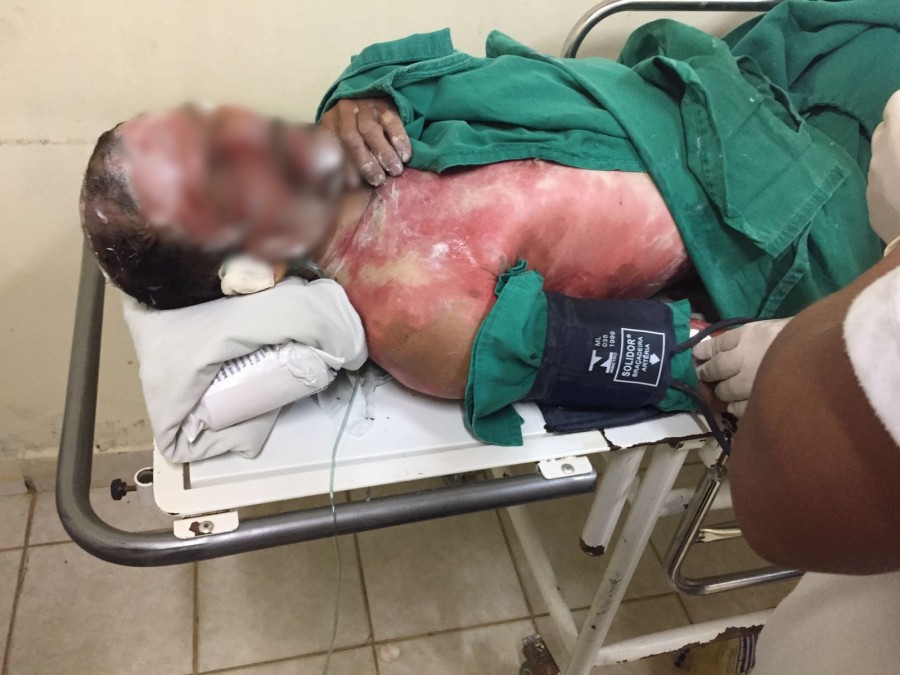 Colono que teve 90% do corpo queimado morre no Huerb; acusado do crime está preso
