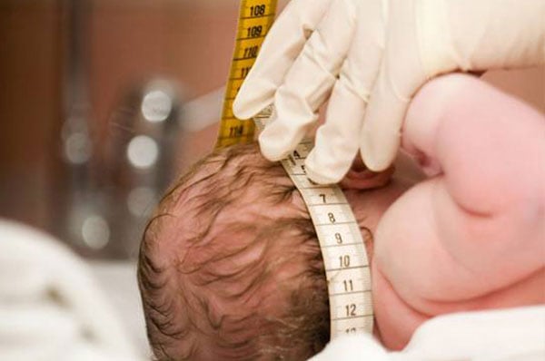 micricefalia-reproduc