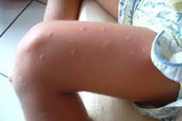 Peru registra 1º caso chikungunya; paciente mora na fronteira