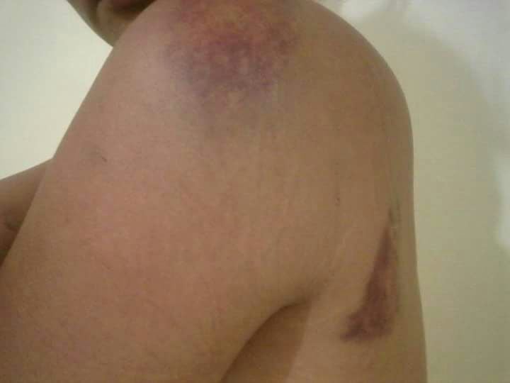 Maria divulgou as fotos dos hematomas no Facebook/Foto: Arquivo Pessoal