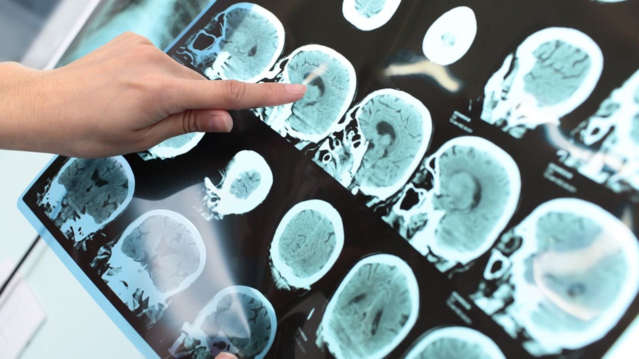 Como reduzir a incidência de Alzheimer e Parkinson