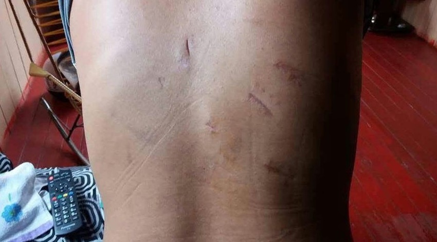 Após ataque do ex, mulher sobrevive a 18 facadas com sequelas físicas e mentais