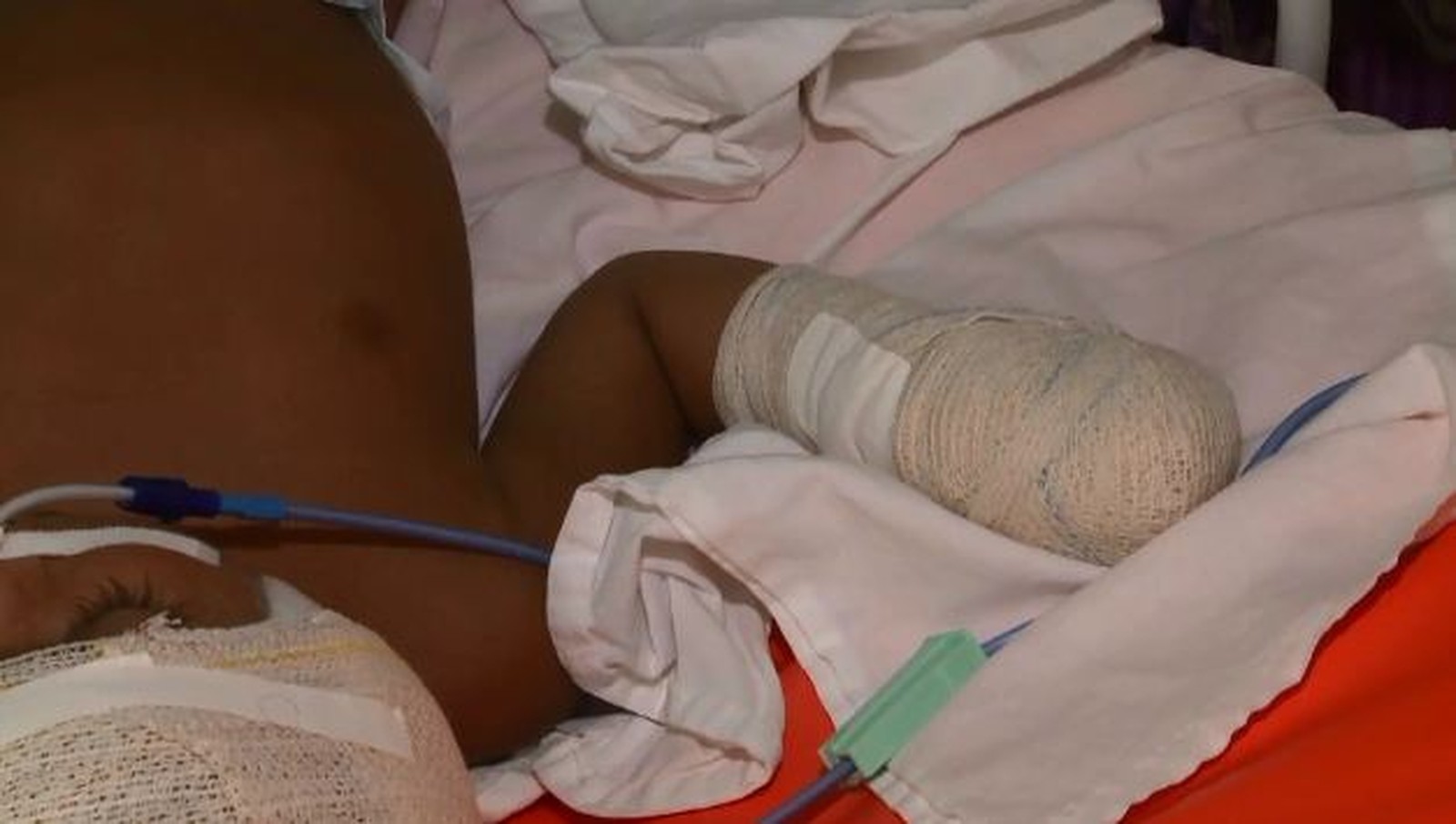 Atingido na cabeça durante tiroteio, bebê perdeu parte do cérebro, diz diretora da UTI