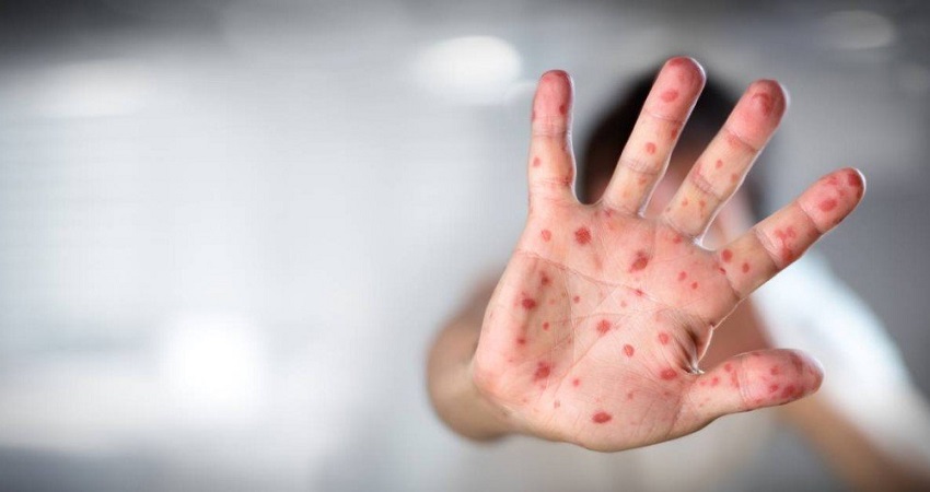Acre já registra seis casos de sarampo; campanha de vacinação é prorrogada até sábado