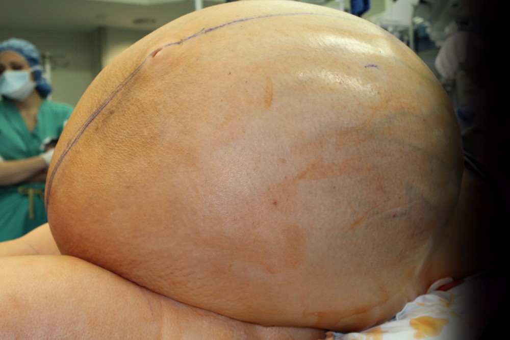 Médicos retiram tumor de 27 kg do útero de mulher