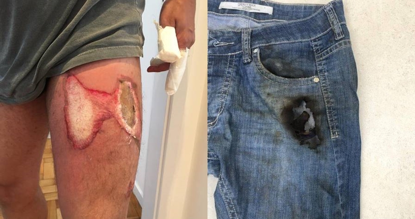 Celular pega fogo no bolso da calça e deixa homem com queimaduras na perna e mãos