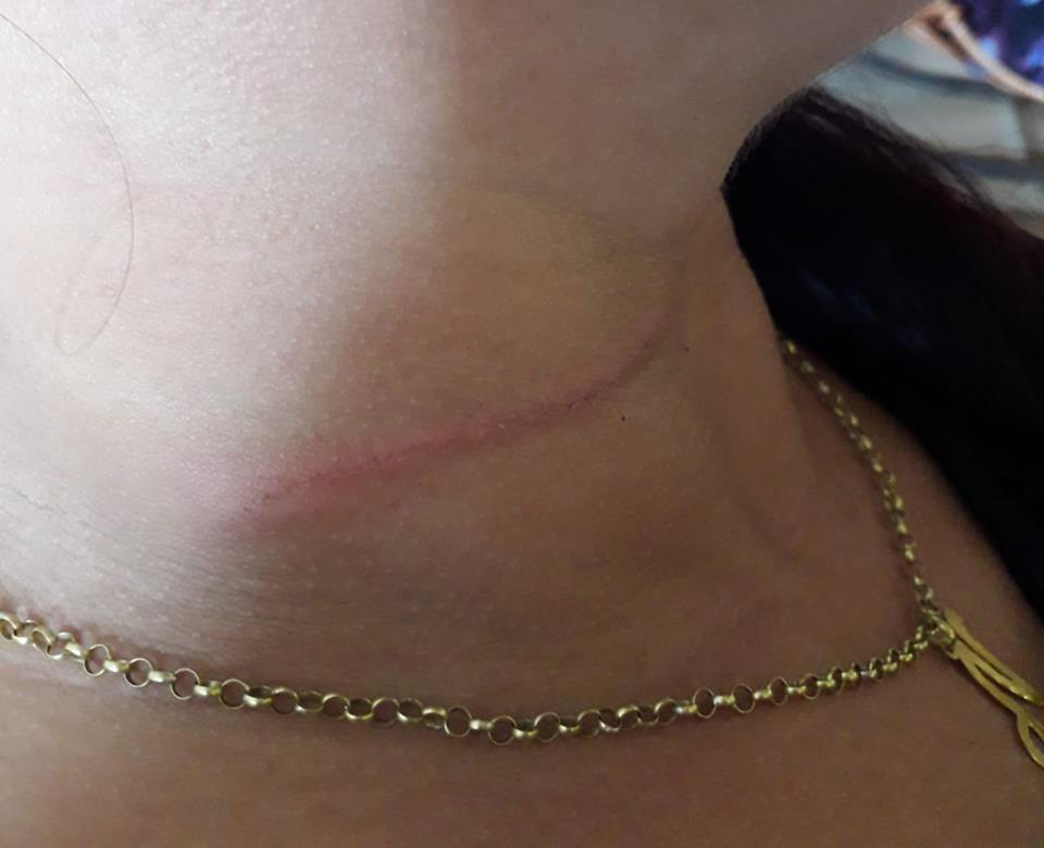 Em Sena, mulher é ferida no pescoço por linha de cerol, enquanto trafegava em moto