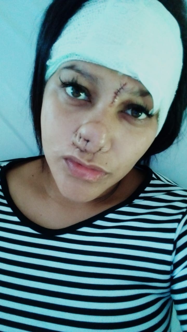 Mulher tem orelha e nariz arrancados a mordida pelo ex-marido: “Terror”