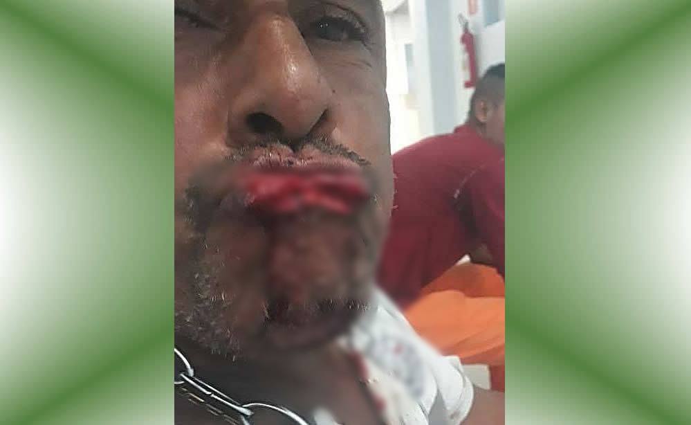Homem tenta beijar mulher à força e tem o lábio arrancado com uma mordida