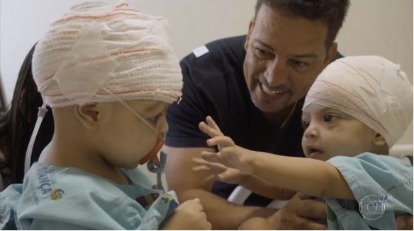Gêmeas siamesas separadas por cirurgia se reencontram pela 1ª vez