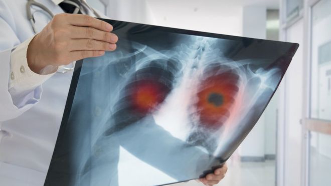 O programa do Google que diagnostica câncer de pulmão ‘com mais eficiência que médicos’