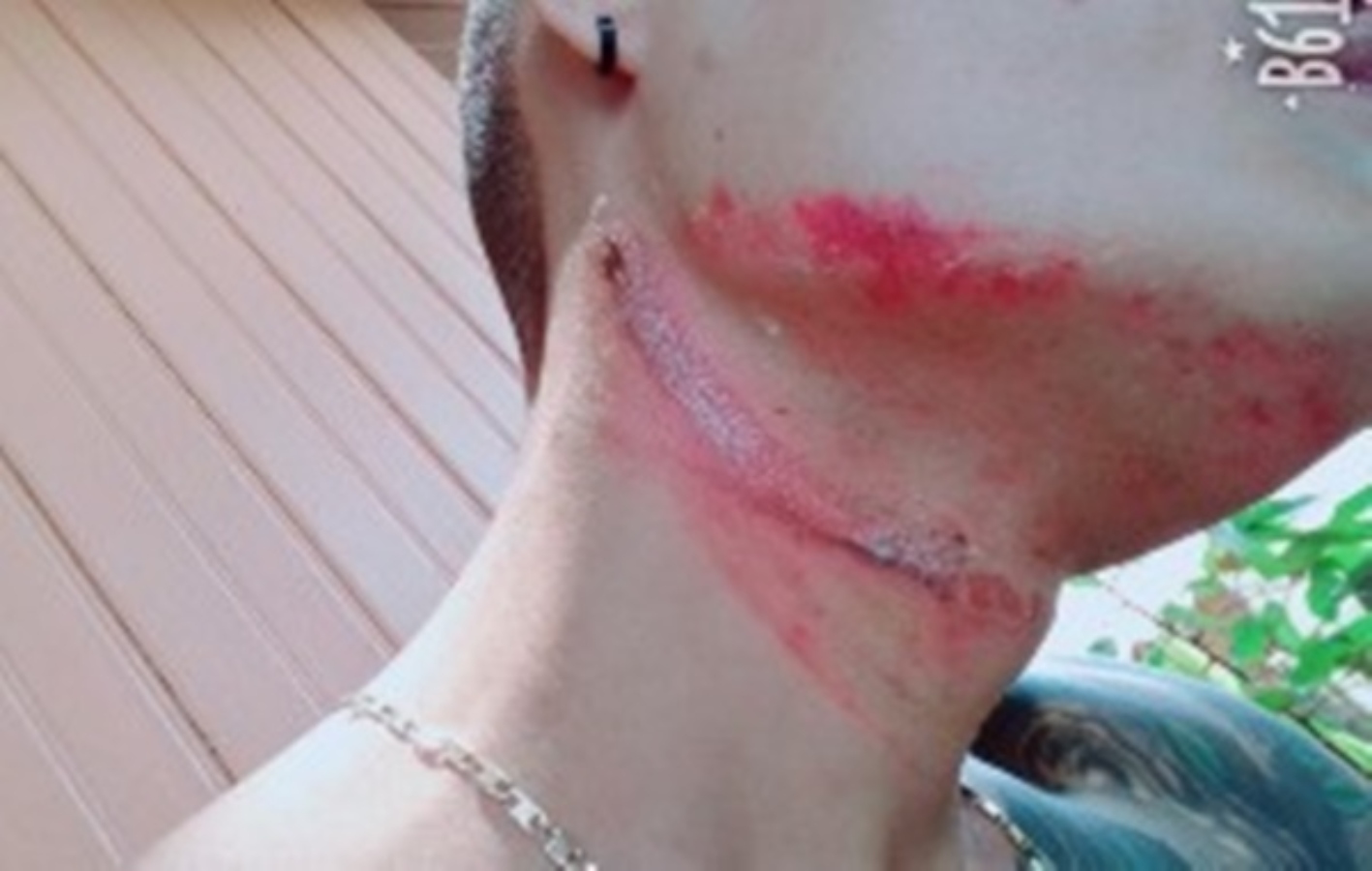 Por pouco estudante não tem pescoço degolado por fio, em Cruzeiro do Sul