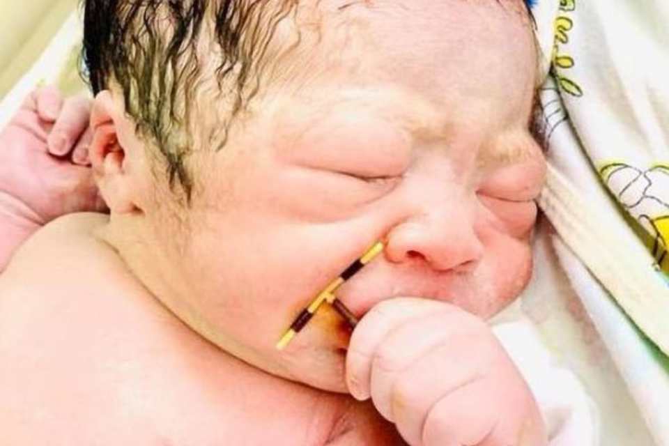 Bebê nasce segurando o dispositivo intrauterino (DIU) da mãe