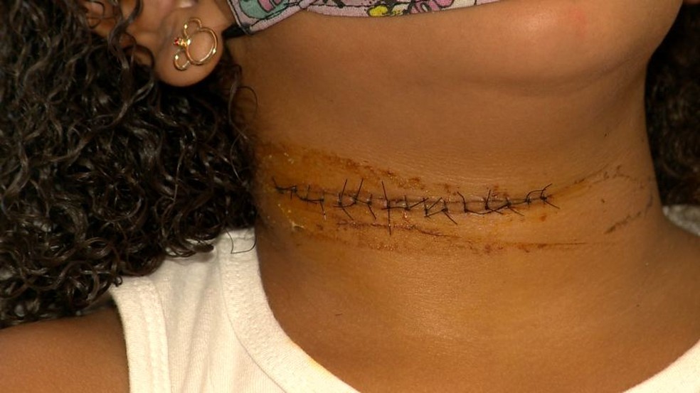 Criança leva 16 pontos no pescoço após ser atingida por linha de pipa com cerol, no ES