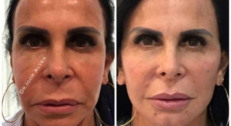 Harmonização facial: Entenda como funciona o procedimento que é febre entre famosos