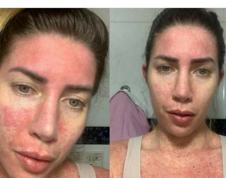 Andressa Urach desmente Tati Minerato, expõe prints e defende médico: “Ela colocou hidrogel”