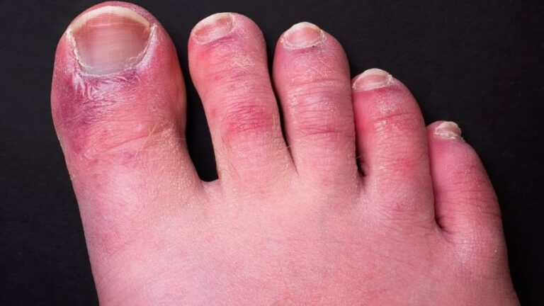 “Dedos de covid” podem durar até 150 dias em pacientes, mostra estudo