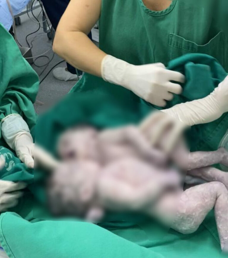 Gêmeas siamesas que nasceram em Rio Branco não resistem e morrem após quase 1 mês