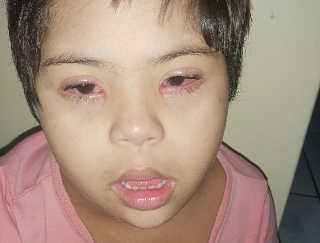 No AC, mãe pede ajuda para conseguir cirurgia para o filho de 9 anos que pode ficar cego