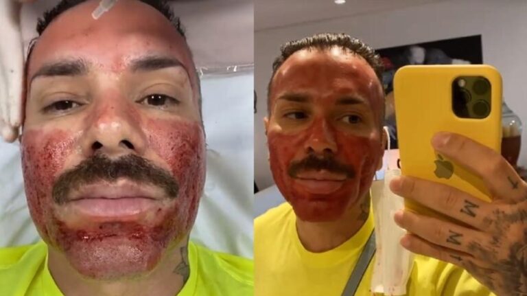 Matheus Mazzafera mostra procedimento que deixa rosto em carne viva