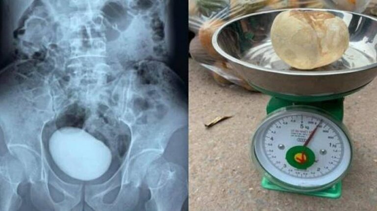 Mulher descobre pedra de quase meio quilo na bexiga ao sentir dores abdominais