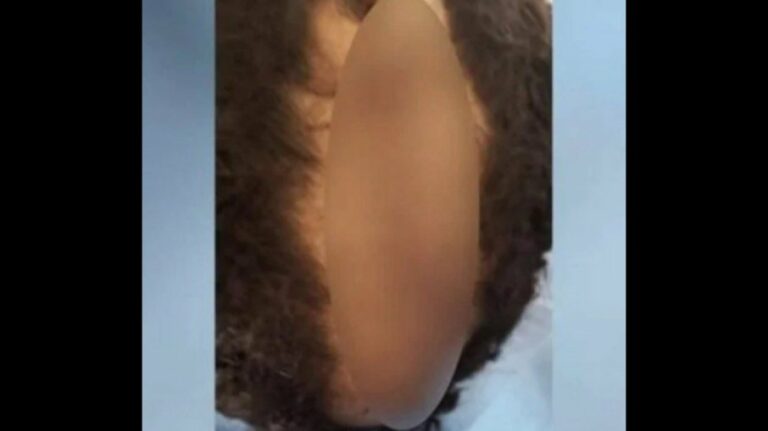 Pai arranca couro cabeludo do filho com faca por achar o corte “homossexual”