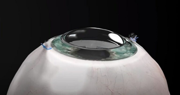 Córnea sintética permite que cego recupere totalmente a visão
