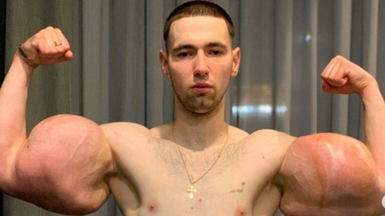 Popeye humano pode perder movimentos dos braços após implantes