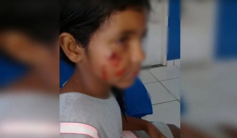 Menina de 8 anos é atacada por cão em rua no Acre e é mordida no rosto