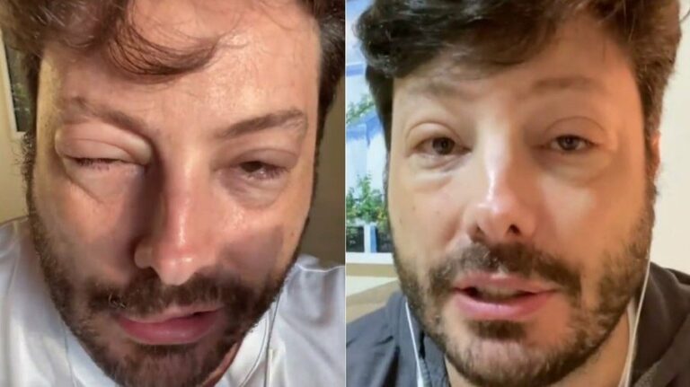 Danilo Gentili surge desfigurado e adianta: “Quase fui pro saco”