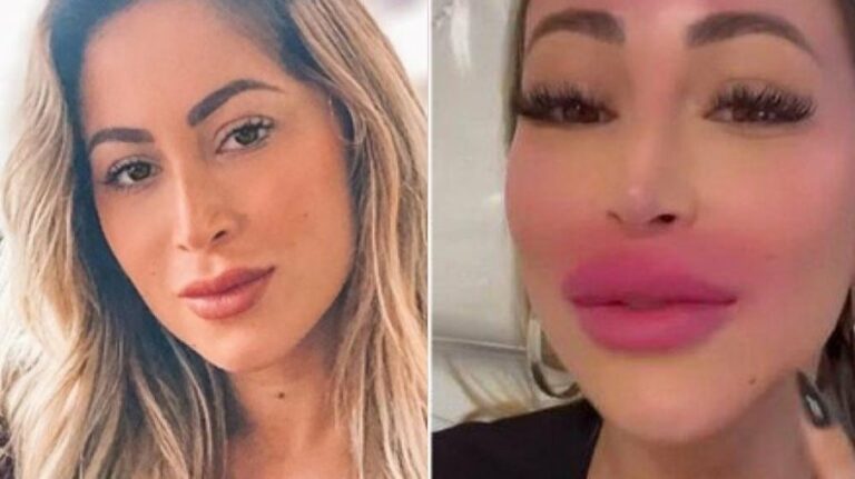 Carol Narizinho faz procedimento e resultado chama atenção dos fãs