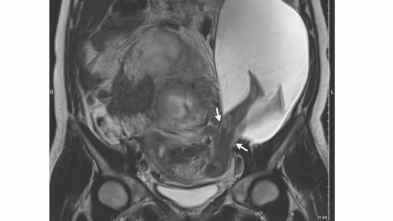 BebĂȘ prematuro coloca as pernas para fora do Ăștero da mĂŁe