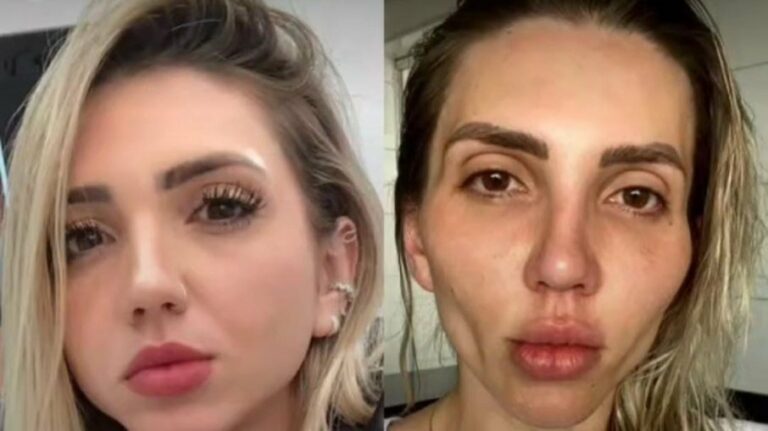 Influenciadora se arrepende de ter feito bichectomia: “Minha cara caiu”
