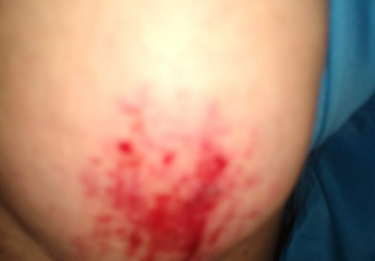 Motorista supostamente alcoolizado atropela o representante da Defesa Civil de Sena