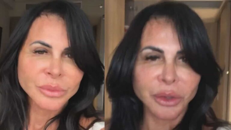 Gretchen exibe resultado de cirurgia plástica: “Sem filtro”