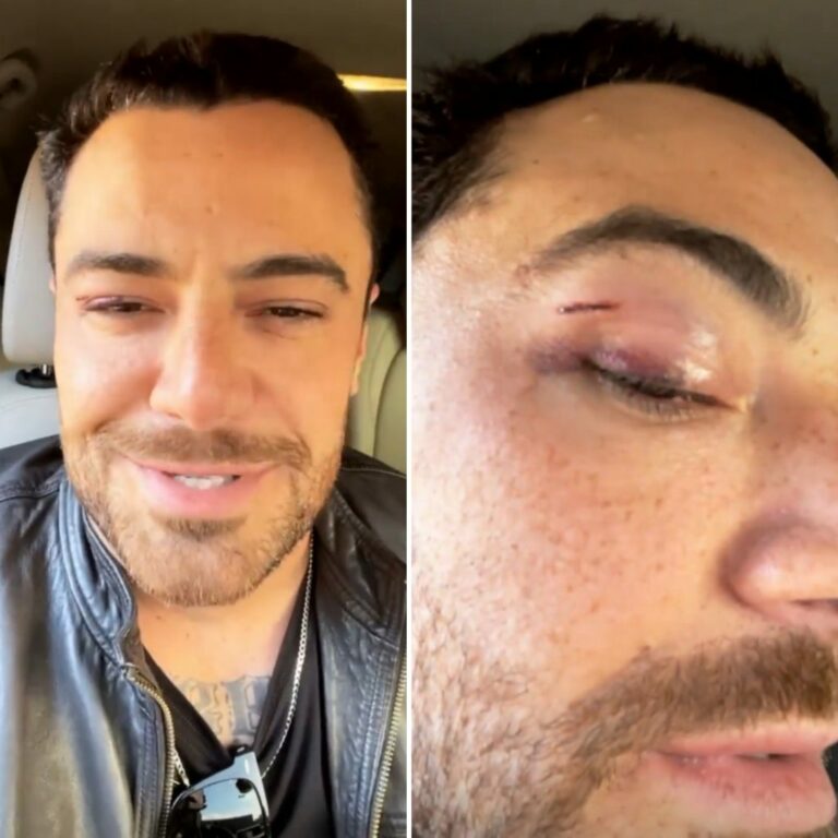 Felipe Titto sofre acidente doméstico; Veja