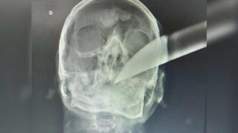 Com faca cravada na cabeça, vítima de assalto continua consciente e pede socorro