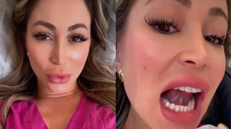 Carol Narizinho faz cirurgia para corrigir língua presa: “Atrapalha para beijar”