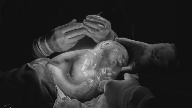 Em fenômeno raro, bebê nasce dentro da bolsa amniótica da mãe; veja