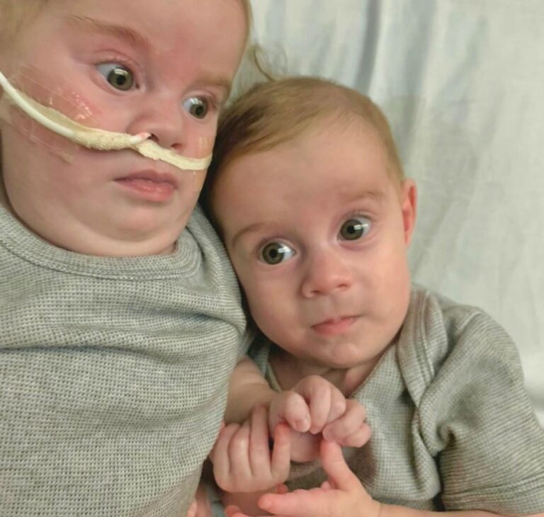 Gêmeas siamesas de RO se reencontram dez meses após cirurgia de separação