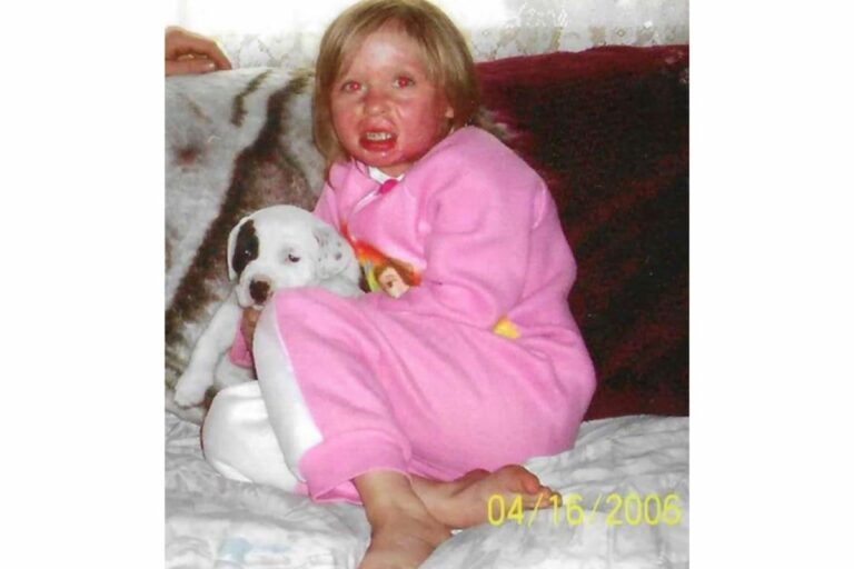 Mãe coloca fogo no cabelo da filha para matar piolhos