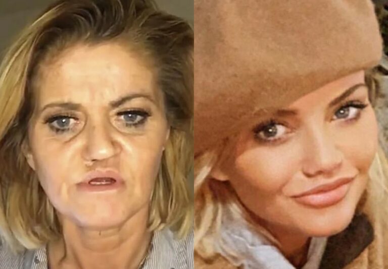 Atriz que teve rosto corroído por cocaína aparece bem diferente após procedimentos