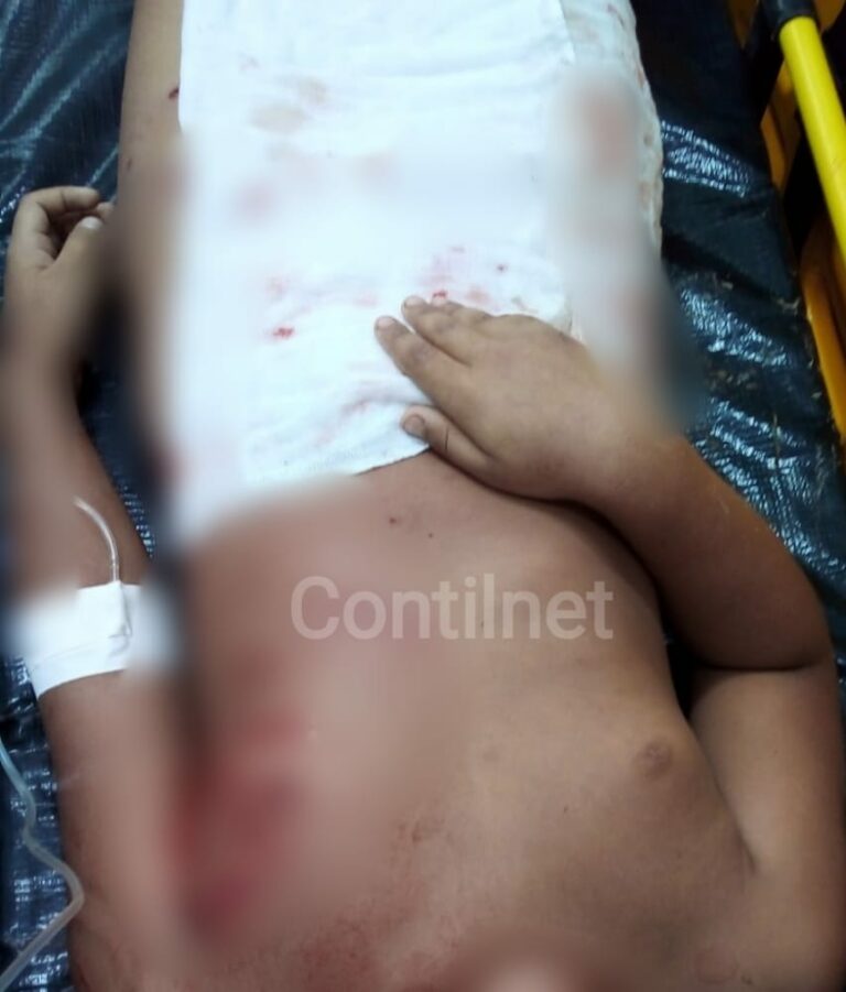 Criança de 8 anos é atacada por três cães da raça pit bull e é salva por familiares em Rio Branco