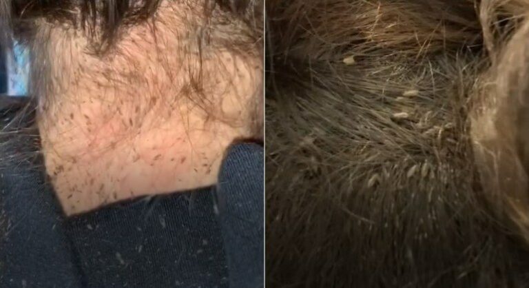 Cabeleireira atende jovem com ‘mais piolhos do que fios de cabelo’