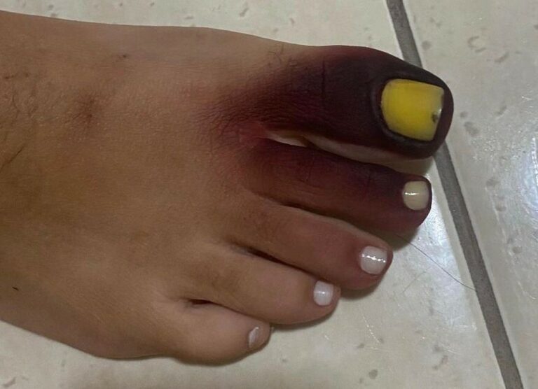 Carioca fica com pé roxo e unha amarela ao calçar tênis com piolho-de-cobra