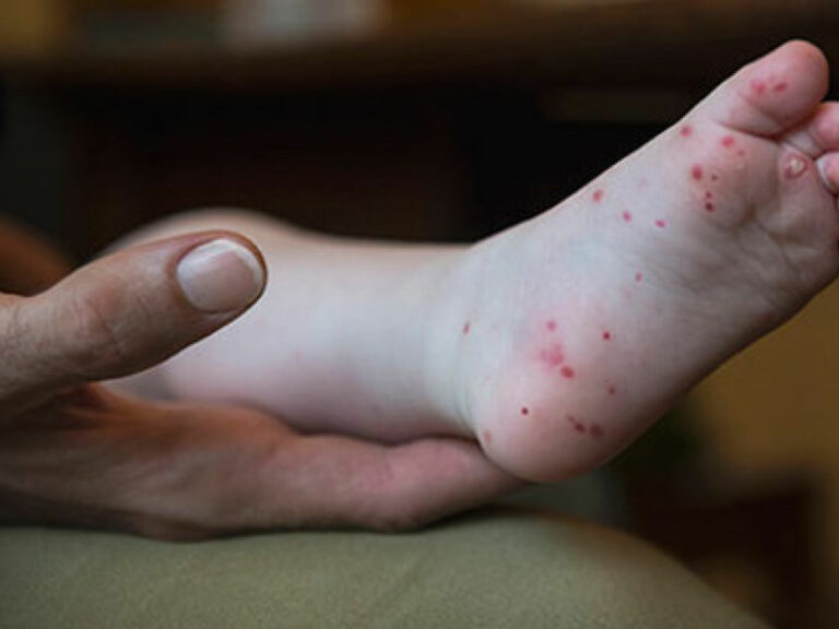 Síndrome mão-pé-boca: saúde alerta para vigilância da doença nos municípios