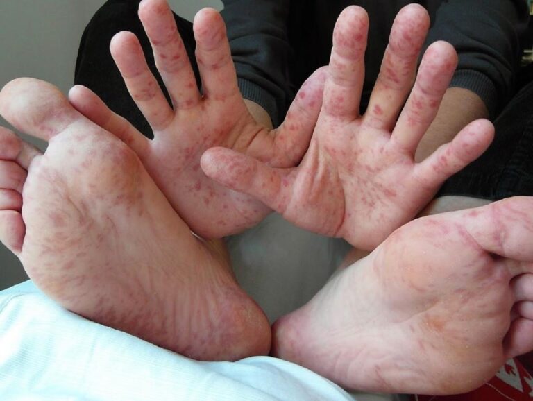 Adulto pode pegar mão-pé-boca? Infectologista explica síndrome que já registra quase 800 casos em Rio Branco