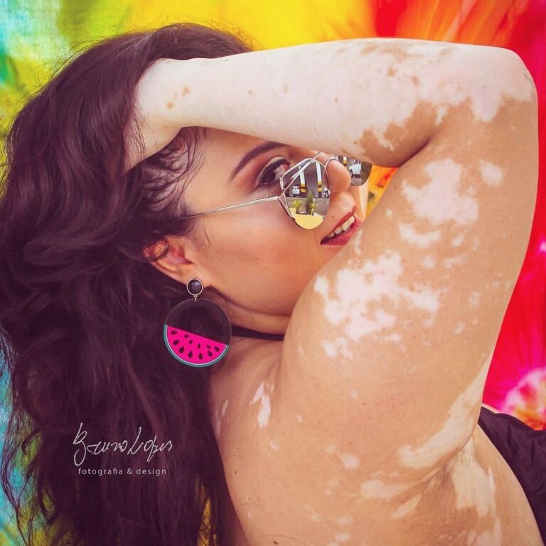 Psicóloga usa a fotografia para combater preconceito contra pessoas com vitiligo